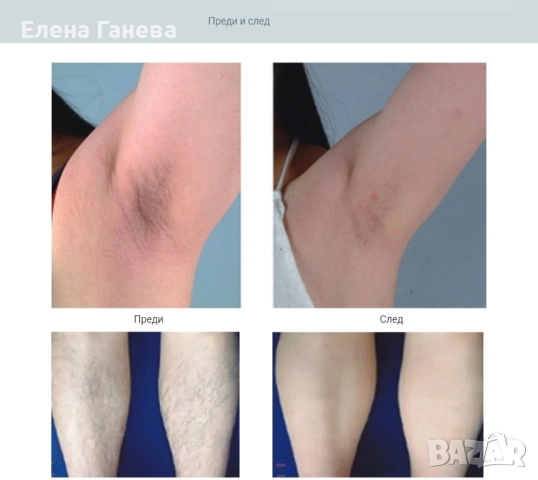 Infinity Clatro – професионален диоден лазер с USA Coherent модул и AI софтуер , снимка 7 - Козметични уреди - 52138694