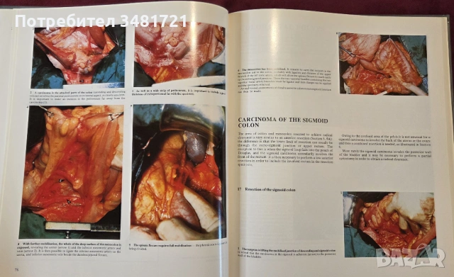 Голям атлас на колоректалната хирургия / A Colour Atlas of Colorectal Surgery, снимка 10 - Специализирана литература - 53748180