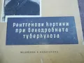 ТУБЕРКОЛОЗА 2210241119, снимка 2