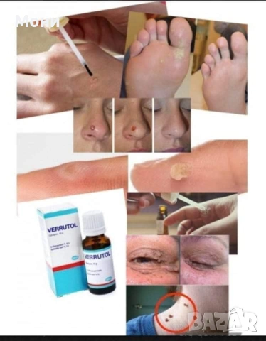 Лак  Верутол за брадавици