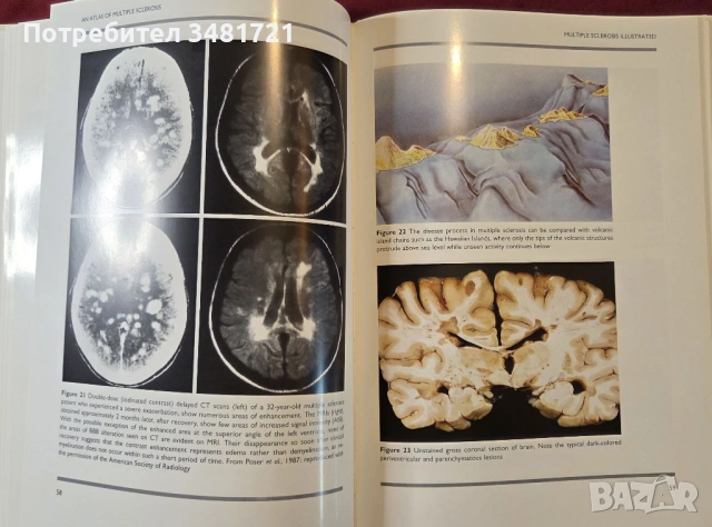 Голям атлас на множествената склероза / An Atlas of Multiple Sclerosis, снимка 8 - Специализирана литература - 53748194