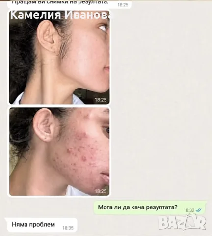 Избелваща Помада Алтън , снимка 5 - Козметика за тяло - 56151384