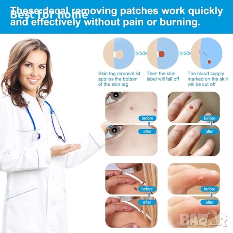 Kioiner Комплект за бързо и безопасно премахване на брадавици, снимка 3 - Други - 52987015