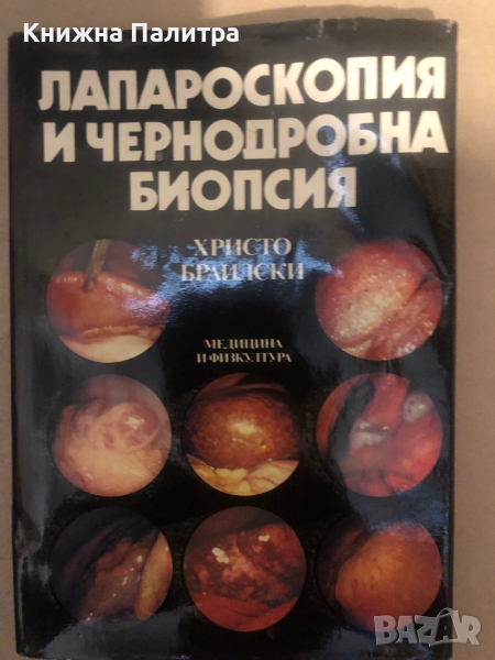 Лапароскопия и чернодробна биопсия Христо Браилски, снимка 1