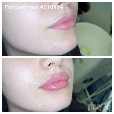  Дермални филъри, снимка 4 - Медицински, стоматологични - 52900689