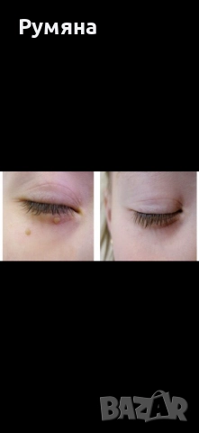 Тинктура срещу папиломи брадавици и кокоши трън , снимка 5 - Други - 52431713