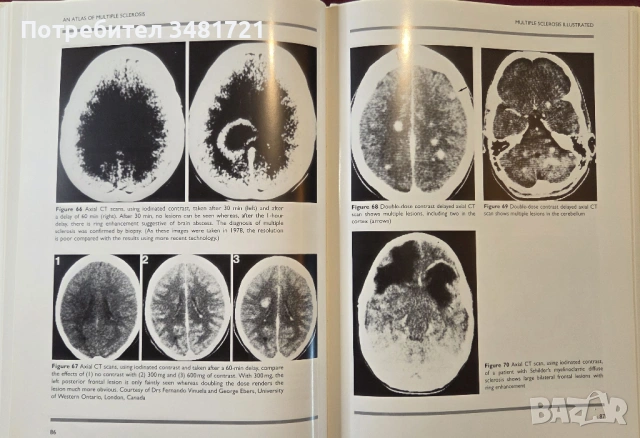 Голям атлас на множествената склероза / An Atlas of Multiple Sclerosis, снимка 12 - Специализирана литература - 53748194