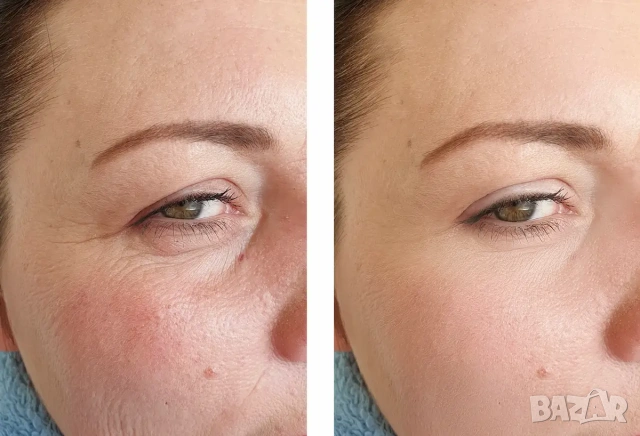 Azaderm azelaic acid Adapalene Хидрохинон за лице за мелазма тъмни петна и хиперпигментация на акне, снимка 6 - Козметика за лице - 50950844