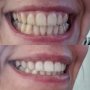 Избелваща паста за зъби EXTRA WHITE PRO 