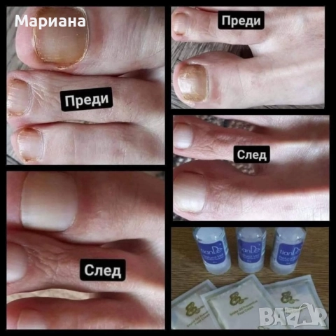 Премахни папиломи, гъбички и други, снимка 4 - Други - 51433055