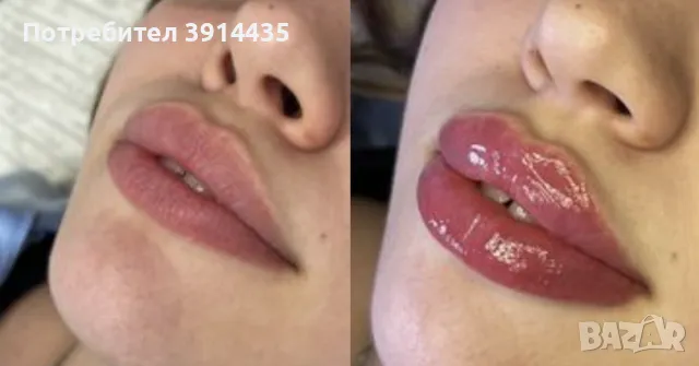 Дермален филър Aileene Vol.2 1 ml, снимка 2 - Козметика за лице - 50222921