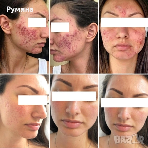 Пчелен мехлем срещу пигментни петна , снимка 3 - Други - 49271744