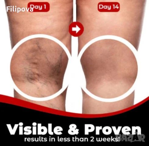 Здравен пластир за лечение на разширени вени Varicose Care Health Patch 12бр, снимка 3 - Други - 49435127