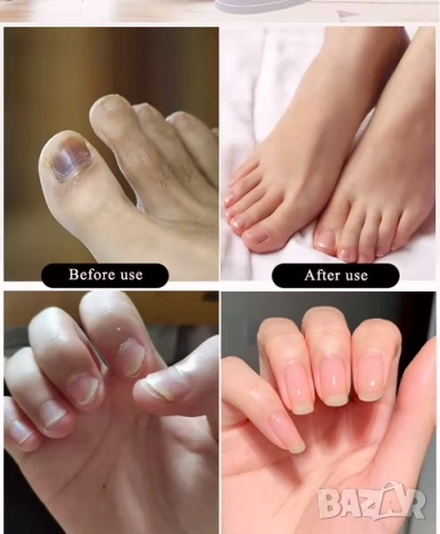 Хит продукт! Ново LED устройство за здрави нокти, Лекува гъбичките с два вида UV светлина!, снимка 2 - Други - 52959366
