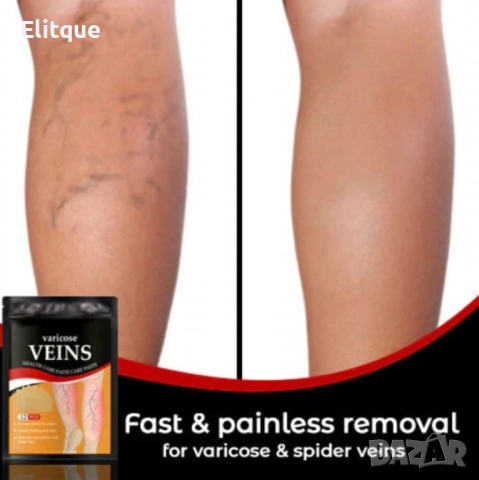 Здравен пластир за лечение на разширени вени Varicose Care Health Patch 12бр, снимка 2 - Други - 52594792