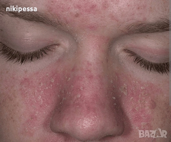 себореен дерматит , себорея , крем , лечение , пъпки, снимка 2 - Козметика за лице - 52524287