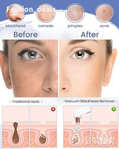 Нова Вакуум машинка за пори черни точки акне на лицето/USB/Жени Мъже, снимка 2 - Калъфи, кейсове - 41662064