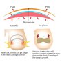 Стикери за Корекция на Нокти Нормализиране Обърнати Нокти Деформирани Нокти Изкривени Нокти Растеж, снимка 7