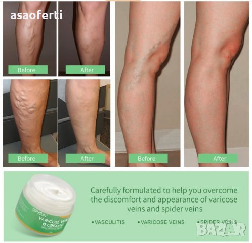 Билков крем за лечение на разширени вени, формула с екстракт от 6 билки, снимка 8 - Други - 39897979