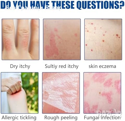 Нов Натурален крем при псориазис – без аромат, нежен към чувствителна кожа, снимка 2 - Други - 53368793