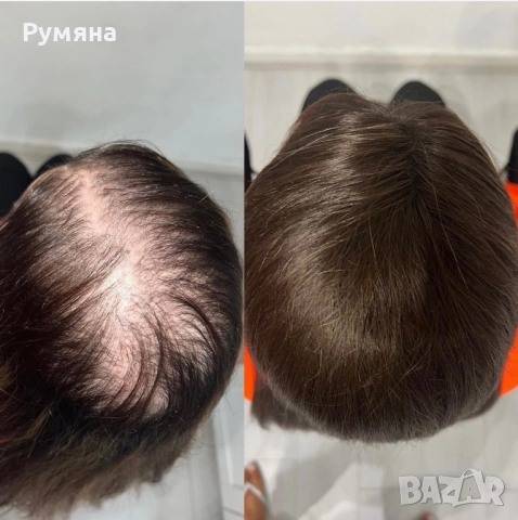 Лосион срещу оплешивяване , снимка 4 - Други - 52431515