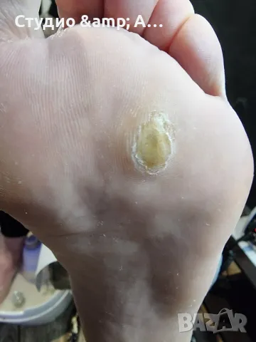 Модул Медицински педикюр, снимка 3 - Курсове за маникюристи - 49209316