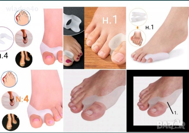Изпъкнали кокалчета ”hallux valgus”-различни видове