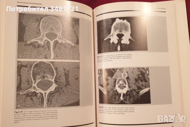 Атлас на остеопорозата / Atlas of Osteoporosis, снимка 9 - Енциклопедии, справочници - 41376795