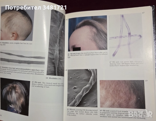 A Colour Atlas of the Hair, Scalp and Nails, снимка 6 - Специализирана литература - 52539726