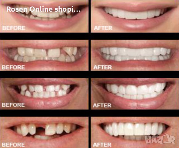 Подарете си перфектна усмивка с иновативната протеза Snap-On Smile, снимка 10 - Декоративна козметика - 44310205