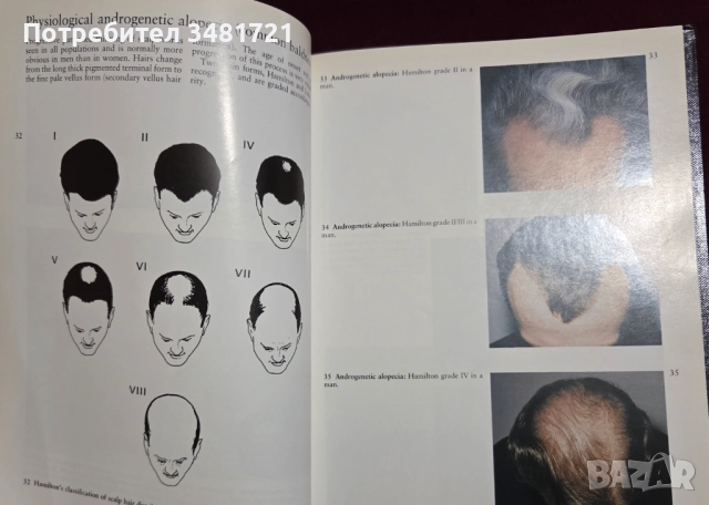 A Colour Atlas of the Hair, Scalp and Nails, снимка 5 - Специализирана литература - 52539726