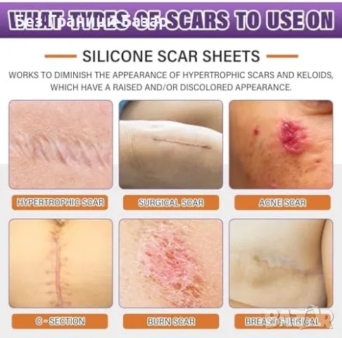 Нова Силиконова лепенка за белези – ефективно намалява стрии, снимка 2 - Други - 49294914