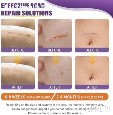 Нова Силиконова лепенка за белези – ефективно намалява стрии, снимка 5 - Други - 49294914