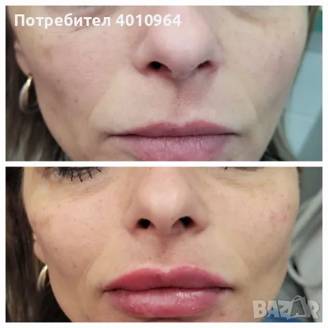 Дермални филъри, снимка 6 - Друго - 44934064