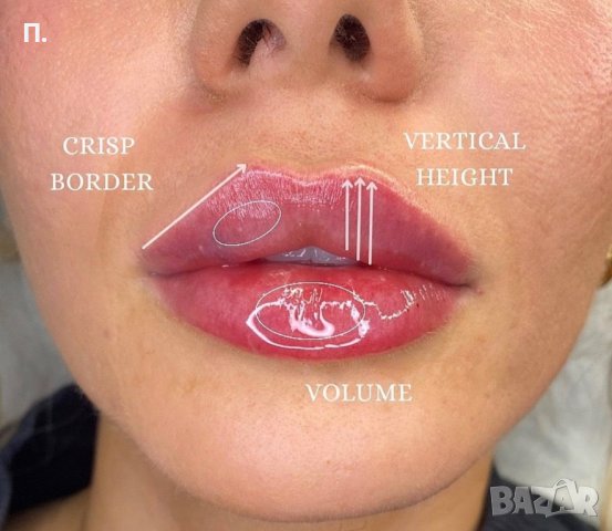 Хиалуронови филъри 5 мл.