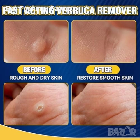 Нов Билков разтвор срещу брадавици и мазоли за ръце и крака 20 мл, снимка 2 - Други - 52123590