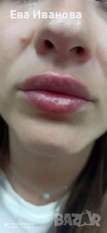 Безиглено уголемяване на устни с хиалурон , снимка 3 - Козметика за лице - 49811971