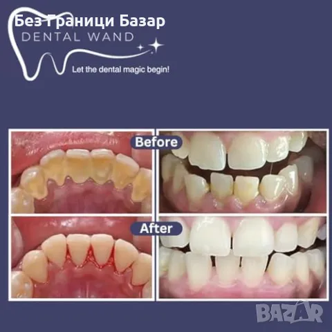 Нов Комплект за почистване на зъби с камера | Премахва плака и зъбен камък, снимка 5 - Други - 47782984