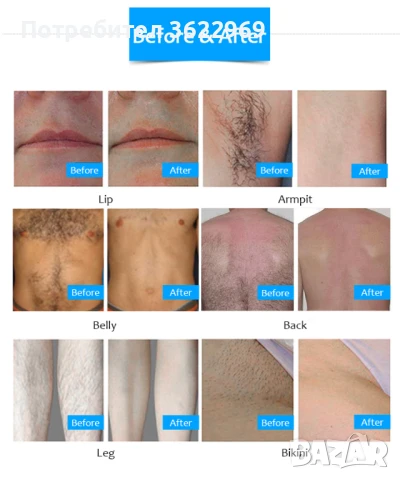 Продавам апарат за лазерна епилация , снимка 7 - Козметични уреди - 47331965