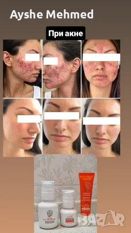 VITA DERM: ПРОФЕСИОНАЛНО РЕШЕНИЕ ЗА ПРОБЛЕМНАТА КОЖА С АКНЕ