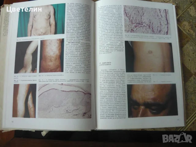 Атлас по кожни болести, снимка 4 - Специализирана литература - 56182965
