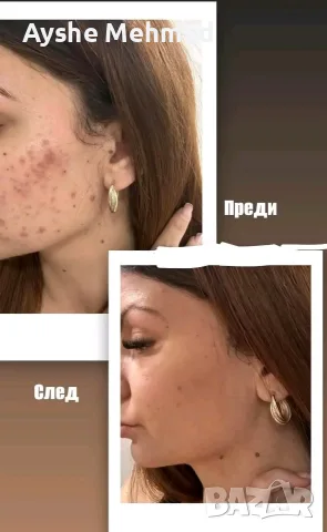 комплект за акне Vita derm 