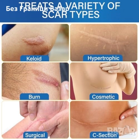 Нов Медицински силикон против белези за жени — дълга и многократна лента, снимка 3 - Други - 51938555