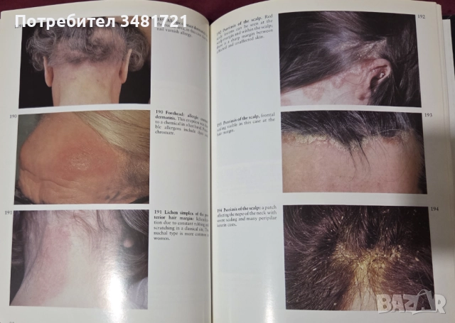 A Colour Atlas of the Hair, Scalp and Nails, снимка 11 - Специализирана литература - 52539726