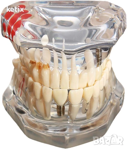 Дентален модел с реставрация