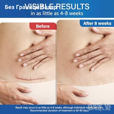 Нов Медицински силикон против белези за жени — дълга и многократна лента, снимка 2 - Други - 51938555