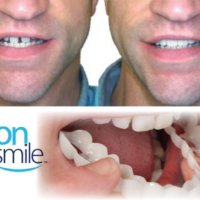 Подарете си перфектна усмивка с иновативната протеза Snap-On Smile, снимка 2 - Декоративна козметика - 44310205