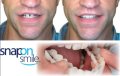 Подарете си перфектна усмивка с иновативната протеза Snap-On Smile, снимка 2
