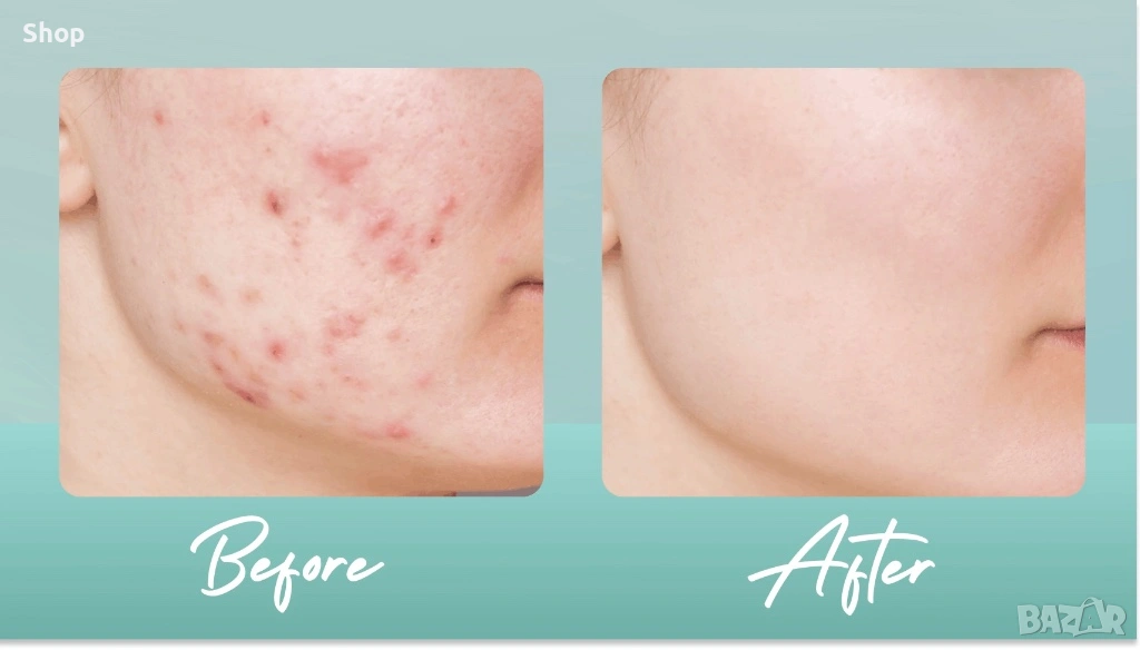 🪞 -10% Крем за акне и пигментация, снимка 1