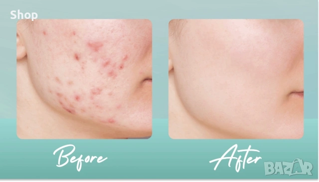 🪞 -10% Крем за акне и пигментация